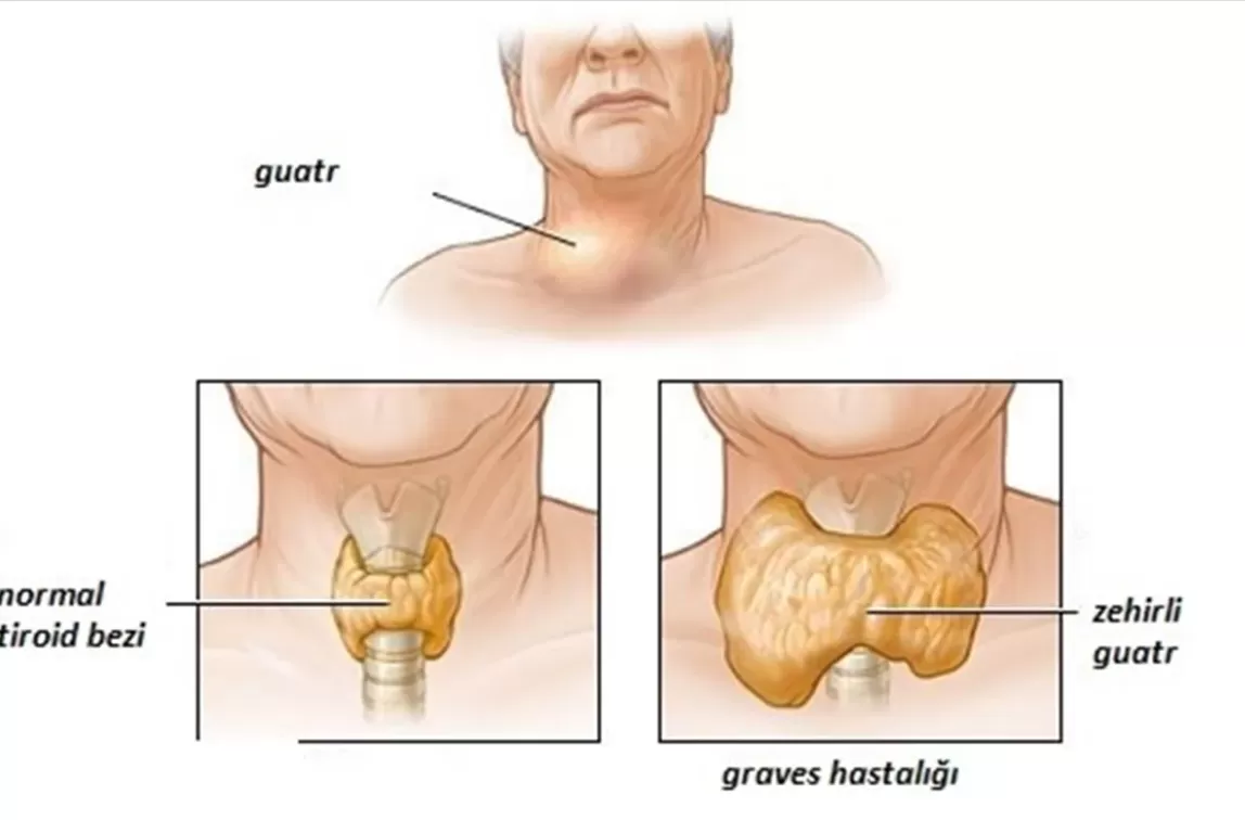 Graves (Zehirli Guatr)